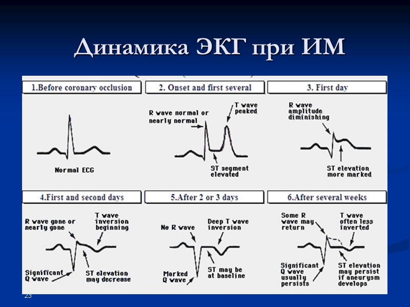 23 Динамика ЭКГ при ИМ